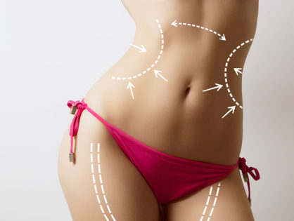 Liposuzione e Liposcultura